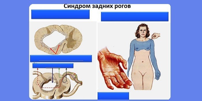 Сирингомієлія шийного або грудного відділів хребта