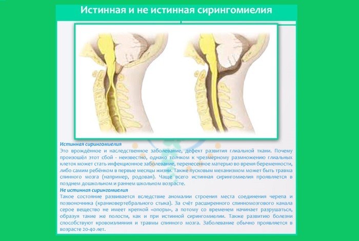 Сирингомієлія шийного або грудного відділів хребта