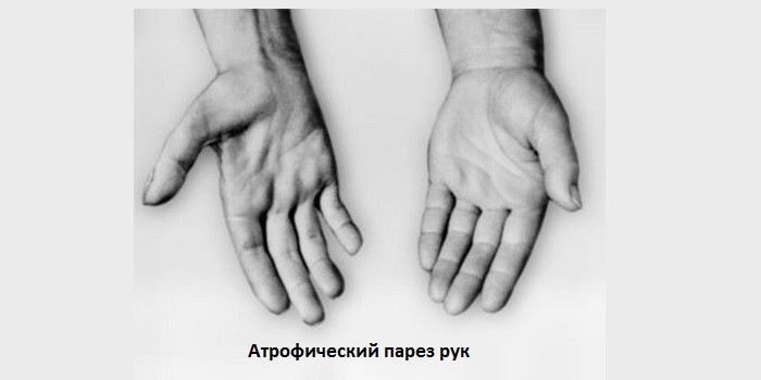 Сирингомієлія шийного або грудного відділів хребта