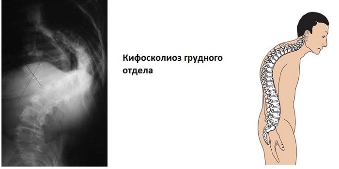 Сирингомієлія шийного або грудного відділів хребта