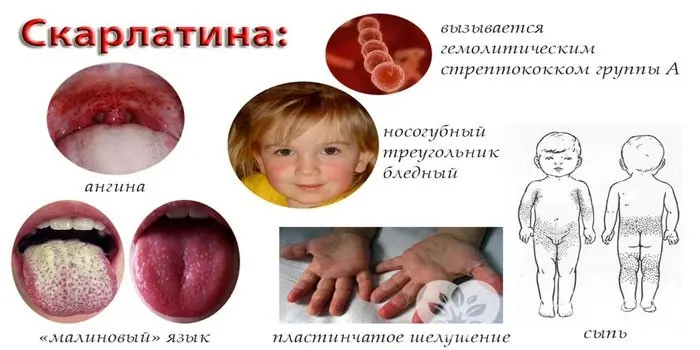 Інкубаційний період скарлатини у дітей після контакту з хворим