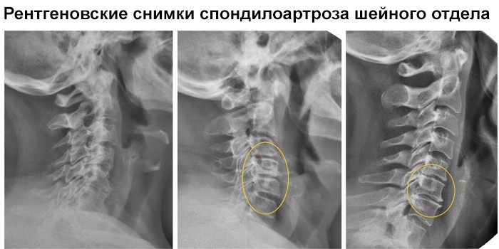 Спондилоартроз шийного відділу хребта - ознаки та як лікувати