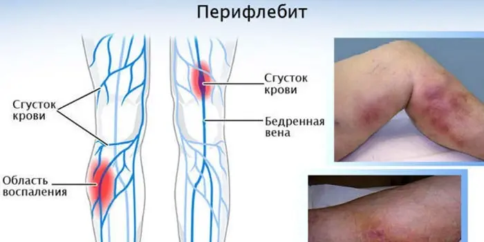 Післяопераційні ускладнення апендициту – характерні ознаки