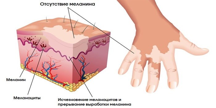 Вітіліго – що це, механізм розвитку, прояви на шкірі та терапія