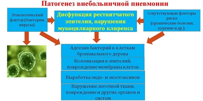 Позалікарняна пневмонія - симптоми, лікування та профілактика