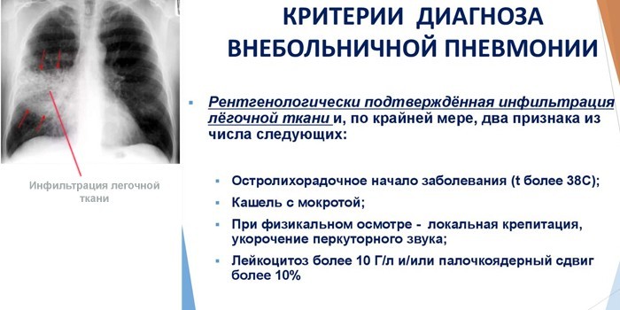 Позалікарняна пневмонія - симптоми, лікування та профілактика