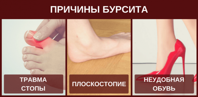 Запалення синовіальної сумки суглоба