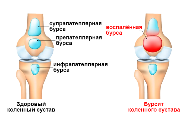 Запалення синовіальної сумки суглоба