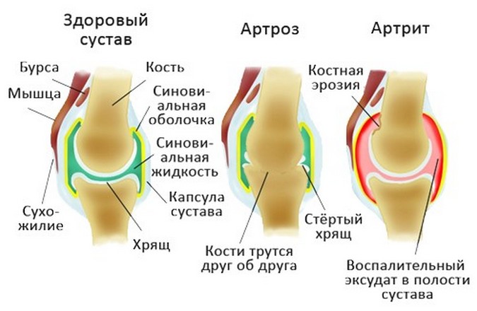 Запалення синовіальної сумки суглоба