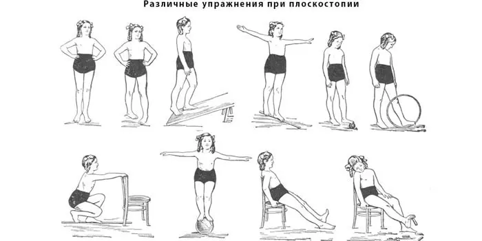 Вправи при плоскостопості у дорослих поперечному або поздовжньому