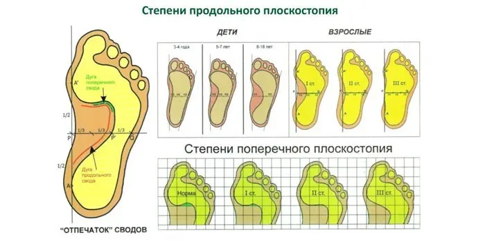 Вправи при плоскостопості у дорослих поперечному або поздовжньому