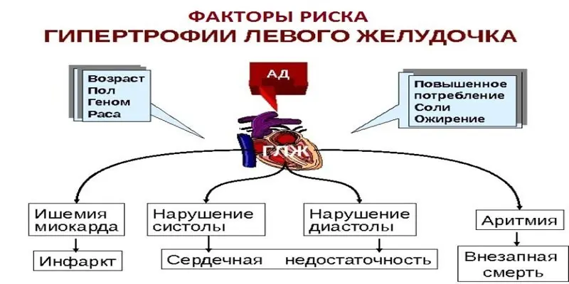 ЕКГ ознаки гіпертрофії лівого шлуночка: зміни при патології