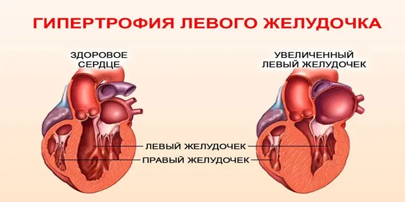 ЕКГ ознаки гіпертрофії лівого шлуночка: зміни при патології