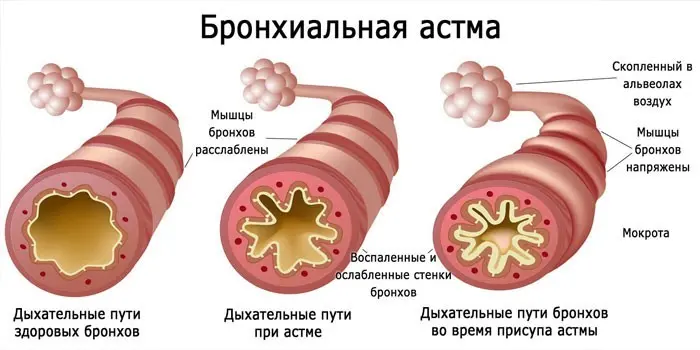 Лікування астми народними засобами - огляд ефективних методів