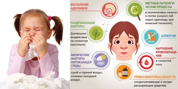 Задній риніт у дитини – як лікувати гострий та вазомоторний.