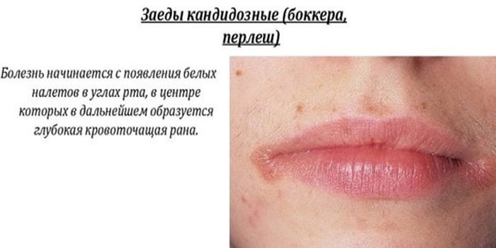 Заїди на губах – причини появи, лікування