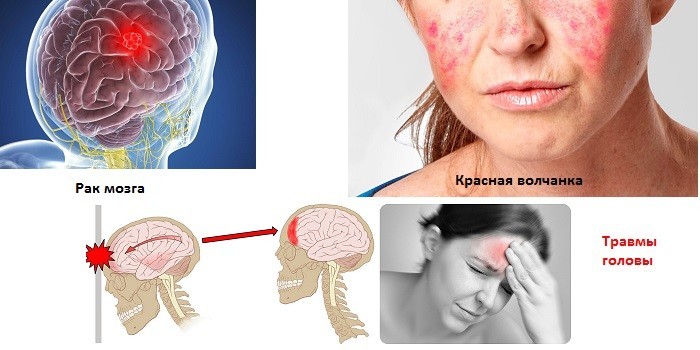 Чи заразен менінгіт - шляхи передачі інфекції у дітей та дорослих
