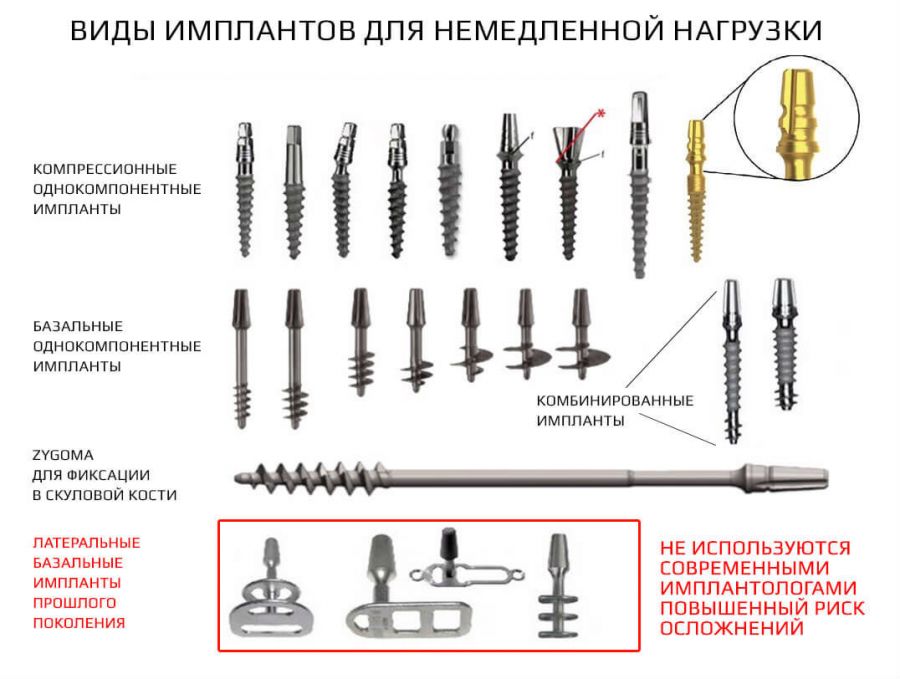 Базальна імплантація зубів: що це таке, відгуки пацієнтів