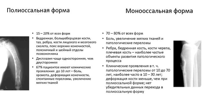 Хвороба Педжета - ознаки, терапія у дітей та дорослих, ускладнення