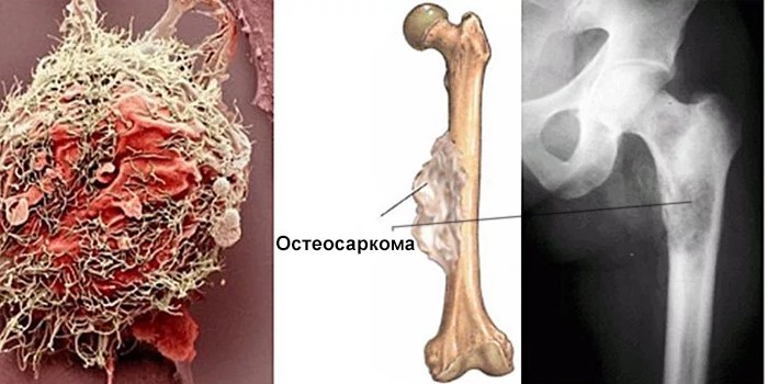 Хвороба Педжета - ознаки, терапія у дітей та дорослих, ускладнення