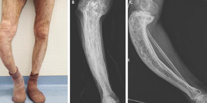 Хвороба Педжета - ознаки, терапія у дітей та дорослих, ускладнення