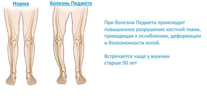 Хвороба Педжета - ознаки, терапія у дітей та дорослих, ускладнення