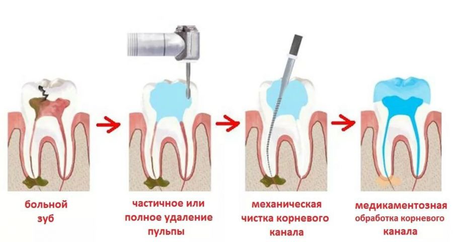 Болить зуб після лікування карієсу, чому він ниє при надкушуванні