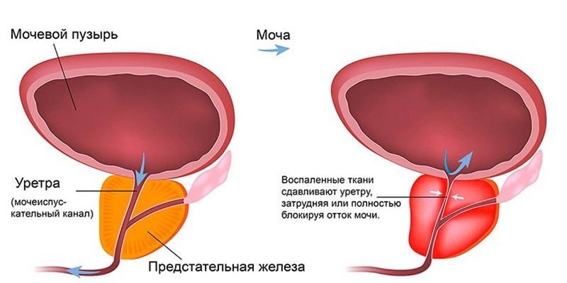 Часті сечовипускання у чоловіків – причини фізіологічні та патологічні, супутні прояви
