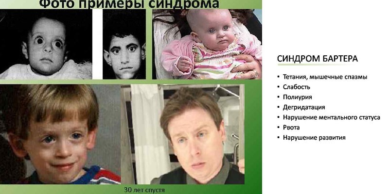 Гіперальдостеронізм – симптоми первинного та вторинного альдостеронізму