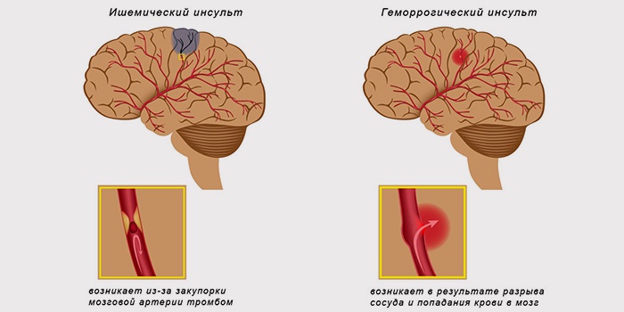 Як лікувати інсульт головного мозку ліками та народними засобами