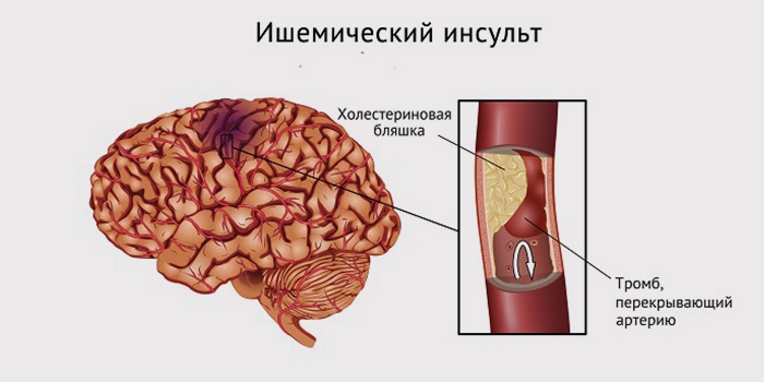Лікувальна фізкультура після інсульту для відновлення вдома