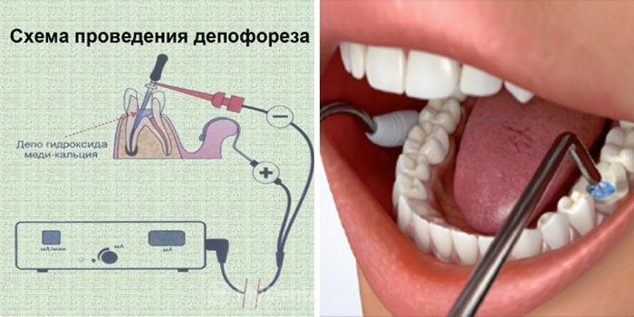 Лікування кісти зуба на яснах: як правильно лікувати, відгуки