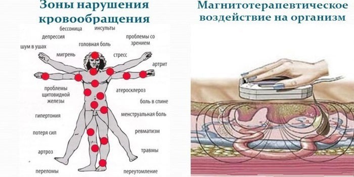 Магнітотерапія - принцип дії, користь та шкода, види апаратів