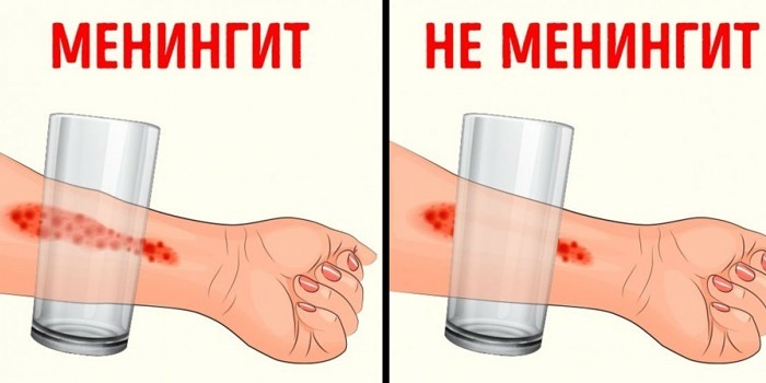 Менінгіт – симптоми та лікування етіотропне, патогенетичне, симптоматичне