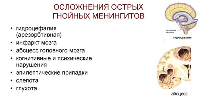 Менінгіт – симптоми та лікування етіотропне, патогенетичне, симптоматичне