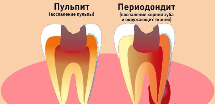 Чому болить зуб під пломбою: причини болю в запломбованому зубі, що робити