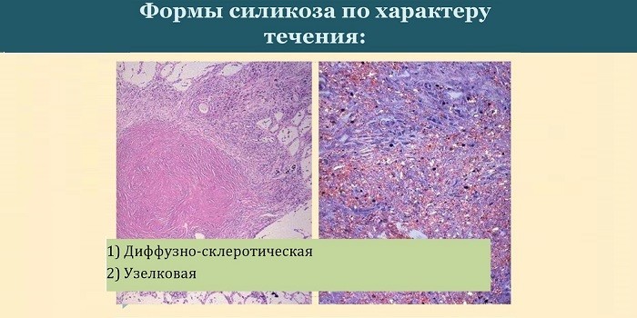 Силікоз: симптоми та лікування хвороби легень