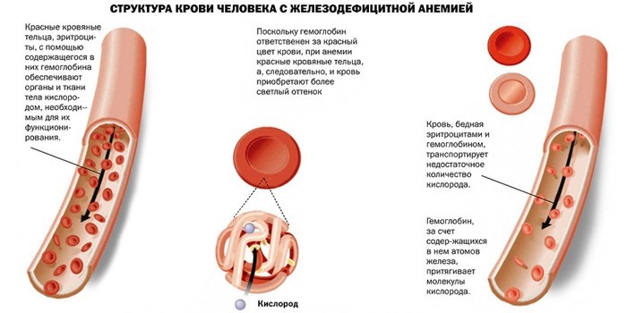 Залізодефіцитна анемія - причини, ступеня та рекомендації