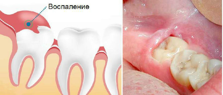 Зуб мудрості (вісімка): чому так називається, фото, будова та розташування, чому видаляють
