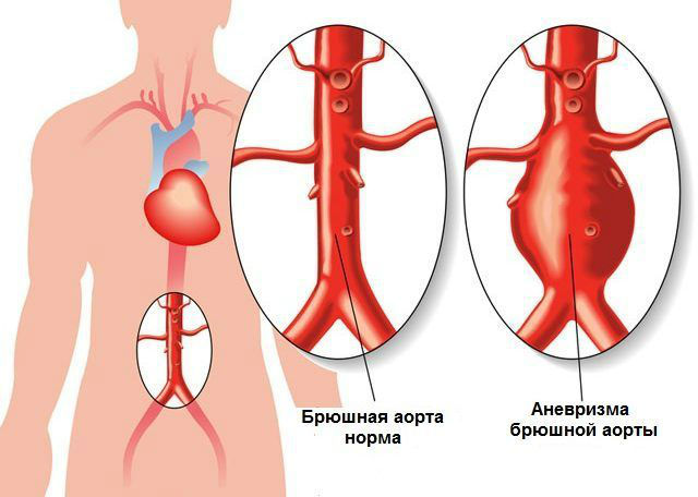 Біль у верхній частині живота по центру, причини чому болить вище за пупок