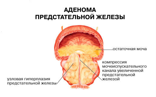 Біль унизу живота у чоловіків, причини болю, що тягне, в нижній частині