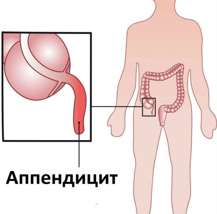 Болить унизу живота справа у чоловіків, причини болю, що тягне, в боці внизу
