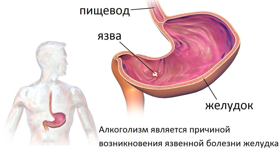 Болить шлунок після алкоголю, чим лікувати болі з похмілля після п'янки