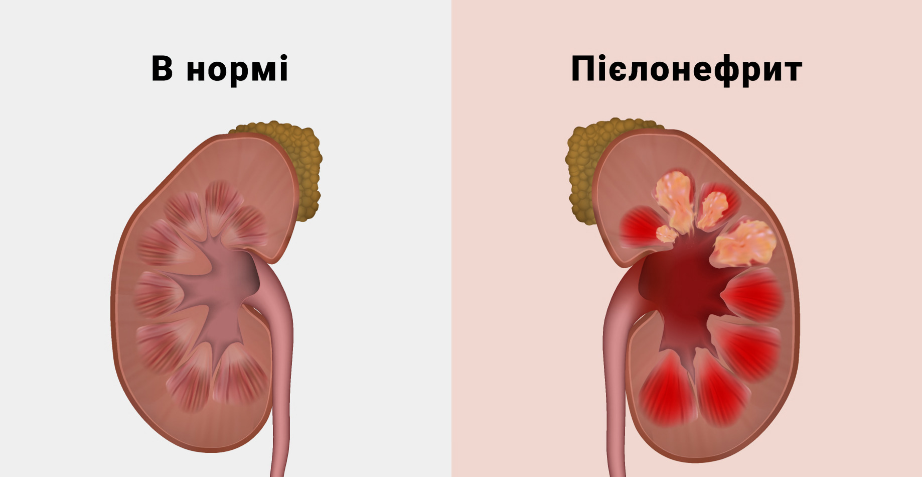 Пієлонефрит
