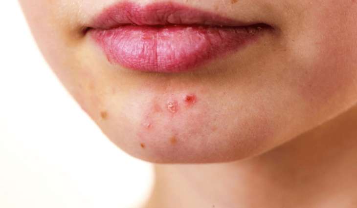 Поради дерматолога: Як швидко і недорого перемогти прищі