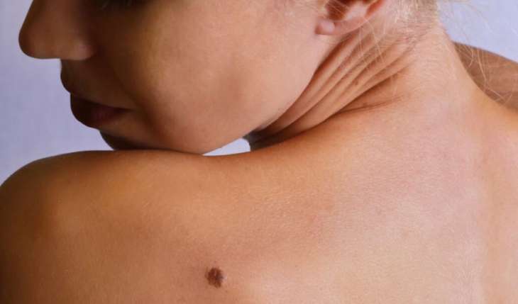 Лікарі розповіли, як відрізнити злоякісні родимки
