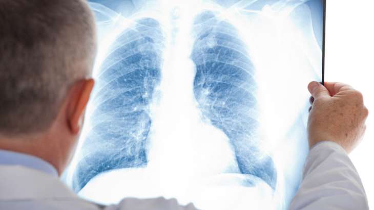 Епідеміолог розповів, хто найчастіше вмирає від пневмонії