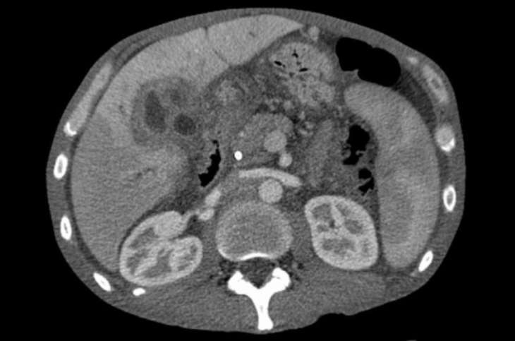 Названо маловідомий симптом раку печінки