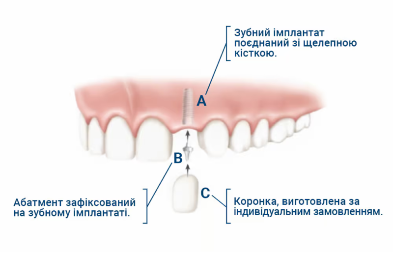 КЕС: провідна клініка з імплантації