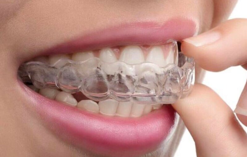 Елайнери Invisalign